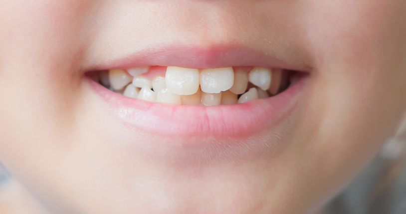 Close up of a child with crooked teeth.